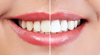 Teeth Whitening Offer Dentist in Canberra
