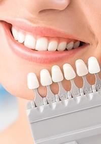 Veneers Offer Dentist in Canberra