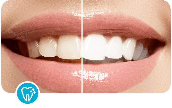 Teeth Whitening Dentist in Canberra