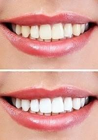 Teeth Whitening Offer Dentist in Canberra